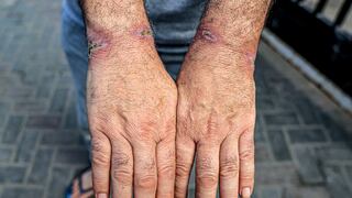 Los palestinos detenidos que están siendo sometidos a amputaciones “de rutina” por lesiones de esposas