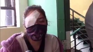 Madre de Dios: enfermera perdió un ojo tras ser atacada con piedras durante paro de cocaleros 