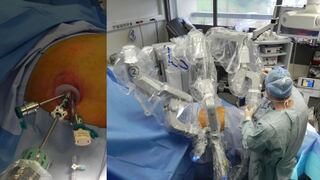 Médicos extirparon parte de riñón canceroso a través del ombligo del paciente