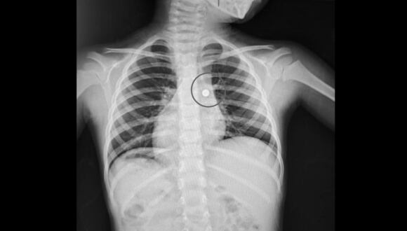 El menor tenía, en el bronquio del pulmón derecho, una pila de reloj de 8mm. Foto: Essalud