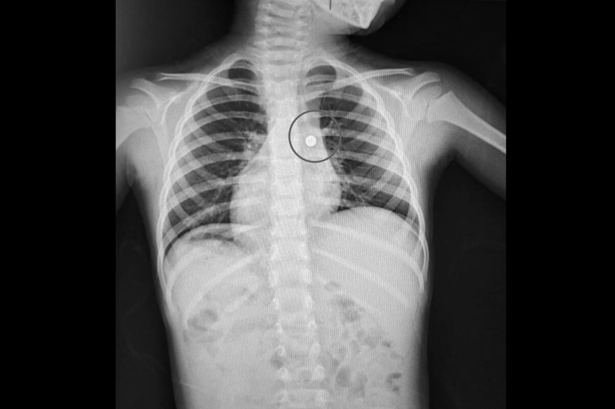 El menor tenía, en el bronquio del pulmón derecho, una pila de reloj de 8mm. Foto: Essalud
