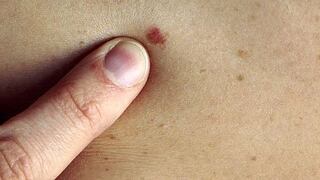 Extirpar ganglios no combatiría cáncer de piel