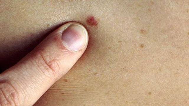 Extirpar ganglios no combatiría cáncer de piel