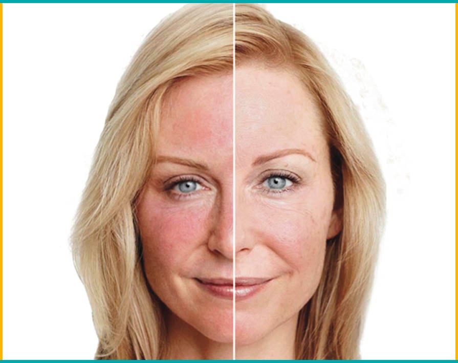 Una adecuada limpieza facial, una dieta equilibrada y someterse a una serie de tratamientos, tales como la terapia con láser, son algunas medidas que se pueden adoptar para controlar los síntomas de la rosácea durante el verano.