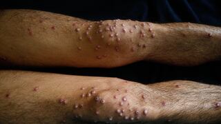 Lima registra 58 casos de viruela de mono en 2024: los distritos con más incidencia de MPOX