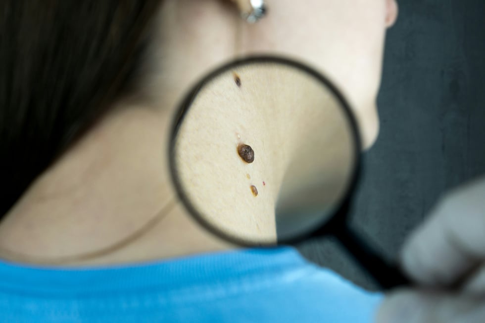 El melanoma se origina en los melanocitos, las células que dan color a la piel. (Foto: Bermix Studio)