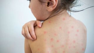 Cuatro de cada diez niños están desprotegidos contra el sarampión: ¿qué pasa con el esquema de vacunación?