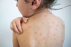 Sarampión en Perú: el reto de ampliar la cobertura de vacunación para la segunda dosis en la población infantil