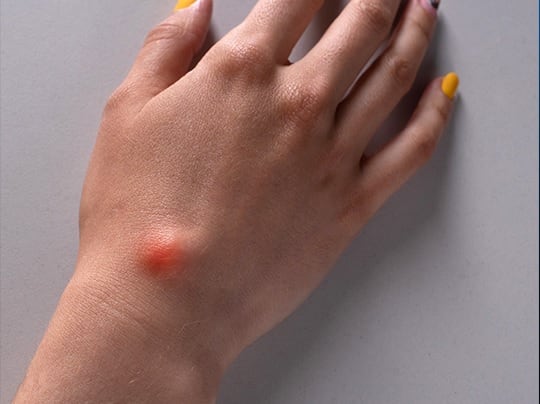 El Sarcoma es considerada una enfermerdad rara que afecta a los huesos y/o tejidos blandos. (Foto: Difusión).