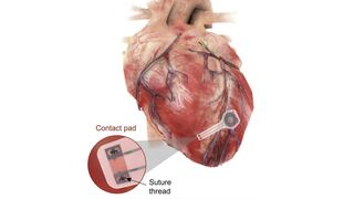 El marcapasos temporal que se disuelve en el cuerpo después de regular el ritmo cardíaco