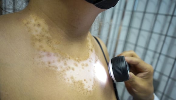 Hospital GuillermoAlmenara aplica innovador tratamiento a pacientes con vitiligo y detiene avance de enfermedad. (Foto: EsSalud)