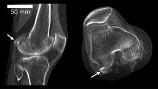 El hueso perdido en la evolución que puede ser el causante de tu dolor en la rodilla