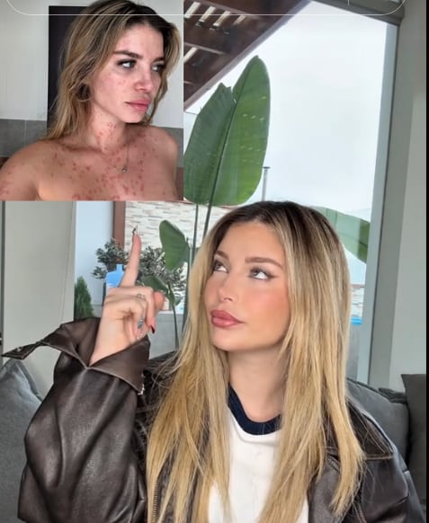 Flavia Laos reveló los efectos de la psoriasis guttata en su cuerpo | Foto: TikTok (Captura)