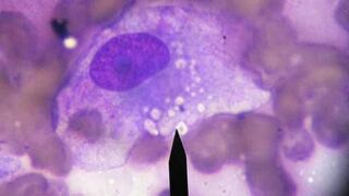 Científicos identifican el origen celular del cáncer de mama