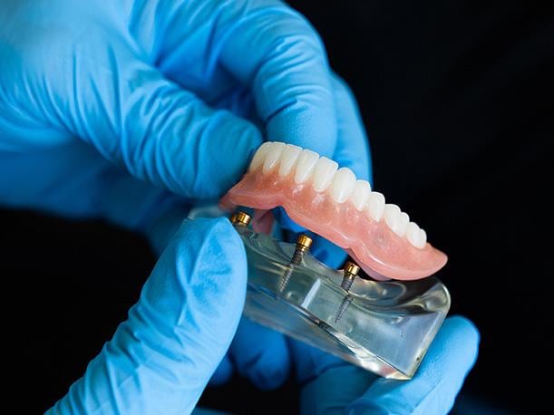 Si una persona utiliza prótesis dental es importante que siga algunas recomendaciones. (Foto: Instituto Daniel Alcides Carrión)