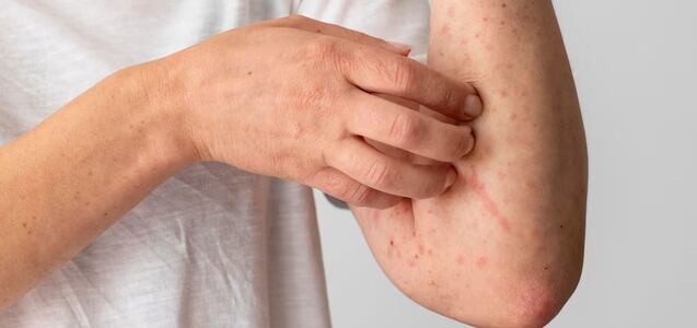 Brote de sarampión en EEUU: cómo puedo protegerme de la enfermedad