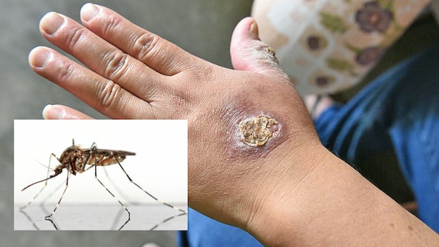 Alerta por aumento de casos de uta transmitida en Lima y regiones: la enfermedad que también se contagia por un mosquito y deja marcas de por vida