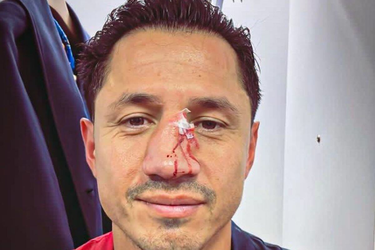 Gianluca Lapadula y el doloroso estado de su nariz tras recibir patada en la cara