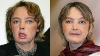 La primera paciente con un rostro trasplantado  [PERFIL]