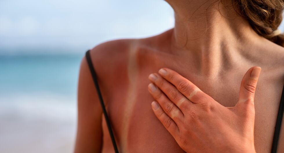 La exposición excesiva y sin protección a los rayos UV puede generar consecuencias permanentes en la piel.