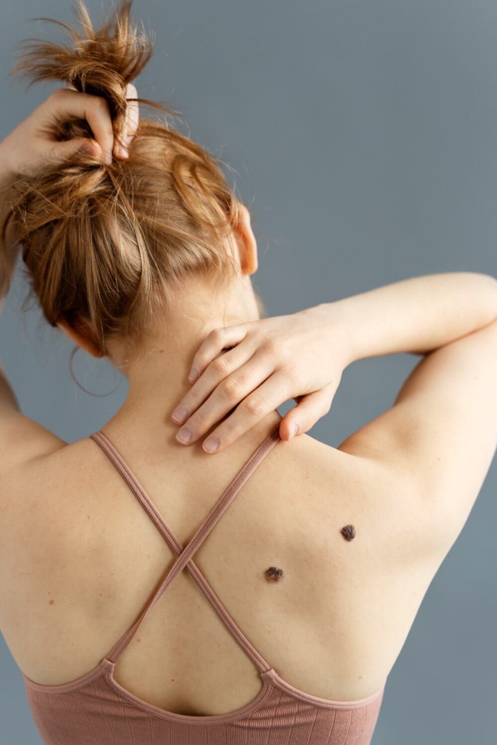 Realizar un autoexamen mensual de lunares implica observar la simetría, los bordes, el color, el diámetro y la evolución