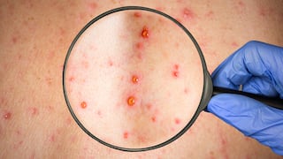 Varicela y sarampión: cómo diferenciar estas enfermedades que brotan en la piel