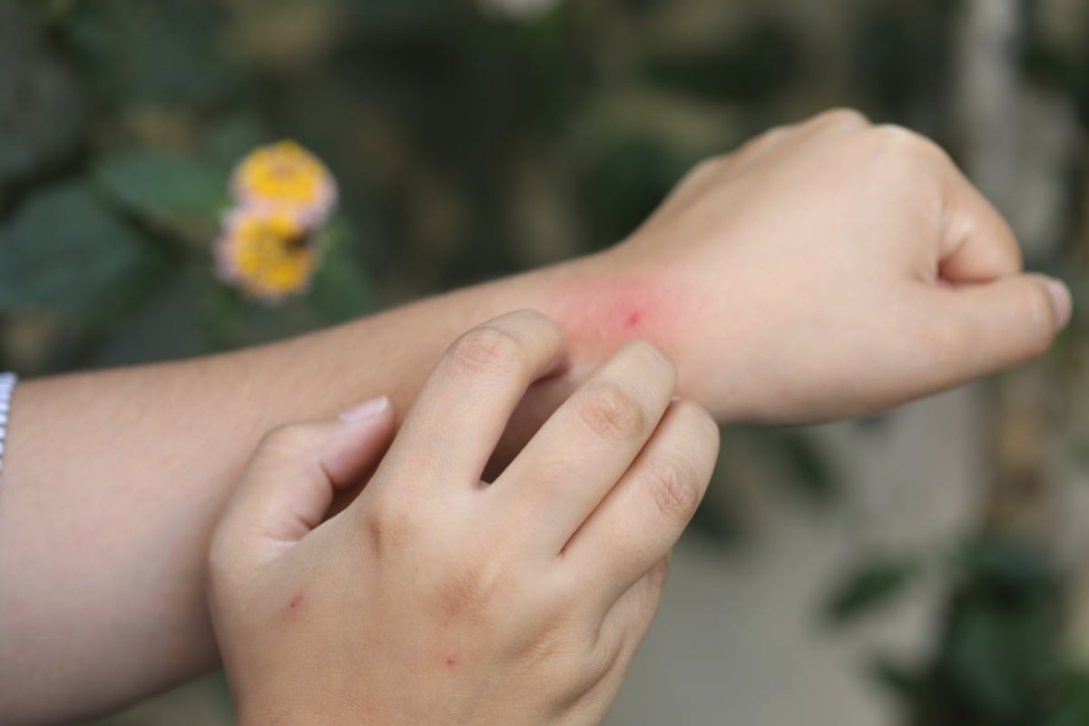 El Ministerio de Salud emitió un alerta ante el aumento significativo en el riesgo de picaduras y mordeduras de insectos. (Foto: Agencias)