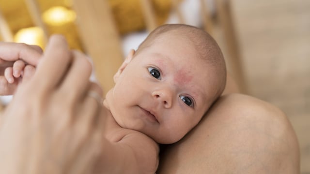 ¿Cómo lidiar con la costra láctea en bebés? Consejos para el adecuado manejo de la piel sensible