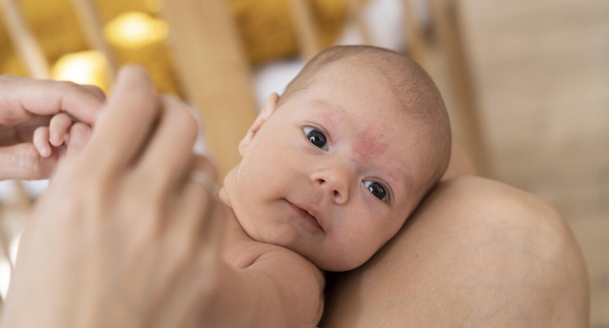 La costra láctea es una afección cutánea común que afecta a muchos bebés recién nacidos.