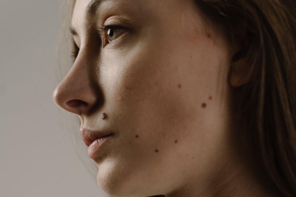 Conoce la razón por la que algunas personas tienen más lunares que otras. (Foto: Pexels/cottonbro).