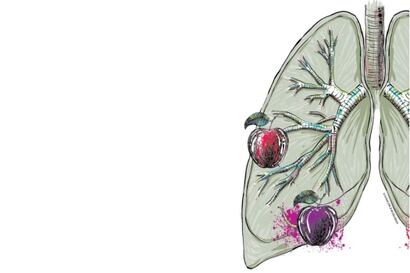 El susto de un nódulo pulmonar