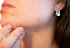 Conoce las 6 zonas en las que suele aparecer el acné