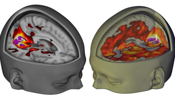 ¿Qué le ocurre al cerebro cuando se consume LSD?