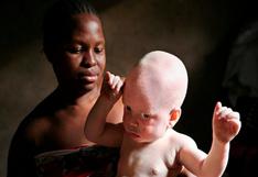 Tanzania: Nuevo caso de asesinato y mutilación de un bebé albino