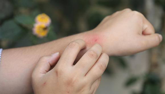 El Ministerio de Salud emitió un alerta ante el aumento significativo en el riesgo de picaduras y mordeduras de insectos. (Foto: Agencias)