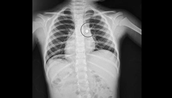 El menor tenía, en el bronquio del pulmón derecho, una pila de reloj de 8mm. Foto: Essalud