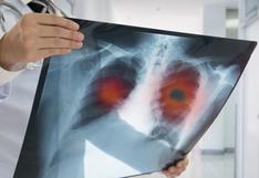 Cáncer de pulmón | El programa de Google que detecta esta enfermedad "con más eficiencia que los médicos"
