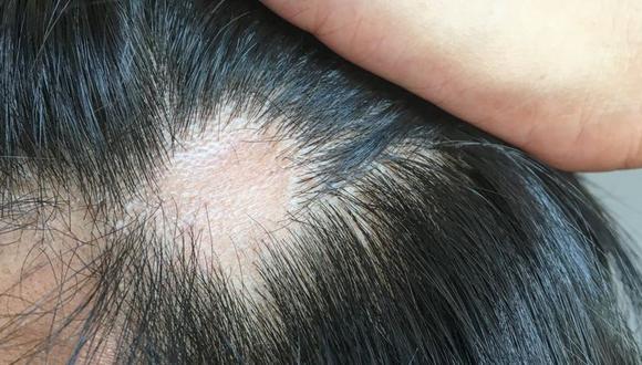 La caída del cabello causada por el coronavirus suele ser temporal. (GETTY IMAGES)