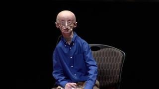 Progeria: el drama de morir de viejo a los 17 años