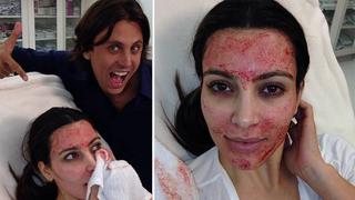 Kim Kardashian y su doloroso tratamiento de belleza: usa su propia sangre