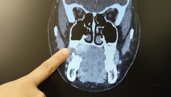 Tumor podía comprometer otros órganos de la paciente. (Foto: INSN Breña)