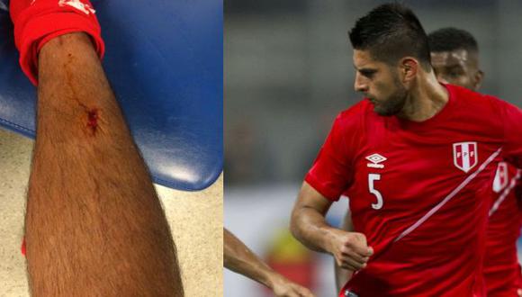 Carlos Zambrano sufrió terrible herida en duelo ante Colombia