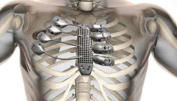 Un paciente con cáncer recibe implante de tórax impreso en 3D