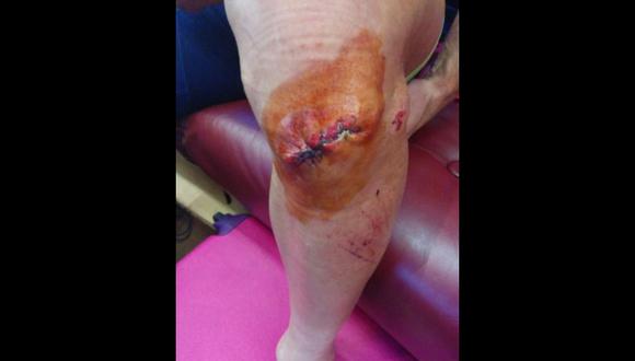 Así quedó la rodilla de un ciclista tras sufrir dura caída