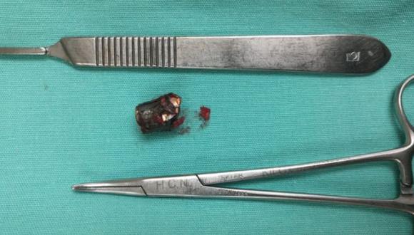 El fragmento de bala que lograron sacarle de la cabeza. Los doctores no pudieron remover algunas esquirlas. (Foto: Ana Gabriela Rojas, via BBC Mundo)