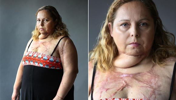 Argentina: Karina Abregú pasó por más de 50 operaciones tras un intento de feminicidio. Foto: La Nación de Argentina/GDA