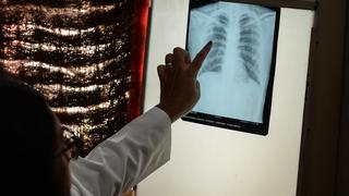 Salud | Descubren que la tuberculosis se puede transmitir en un estado hasta ahora no considerado 
