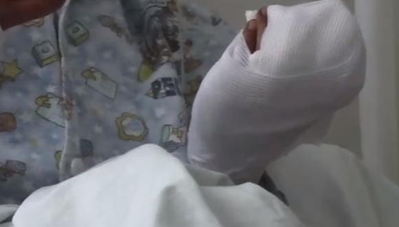 El pequeño tuvo que ser intervenido de emergencia. Su mano izquierda resultó seriamente dañada. (Foto: captura | redes sociales)