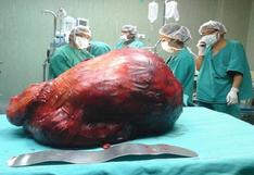 Arequipa: Extirpan tumor de 20 kilos durante operación de 4 horas