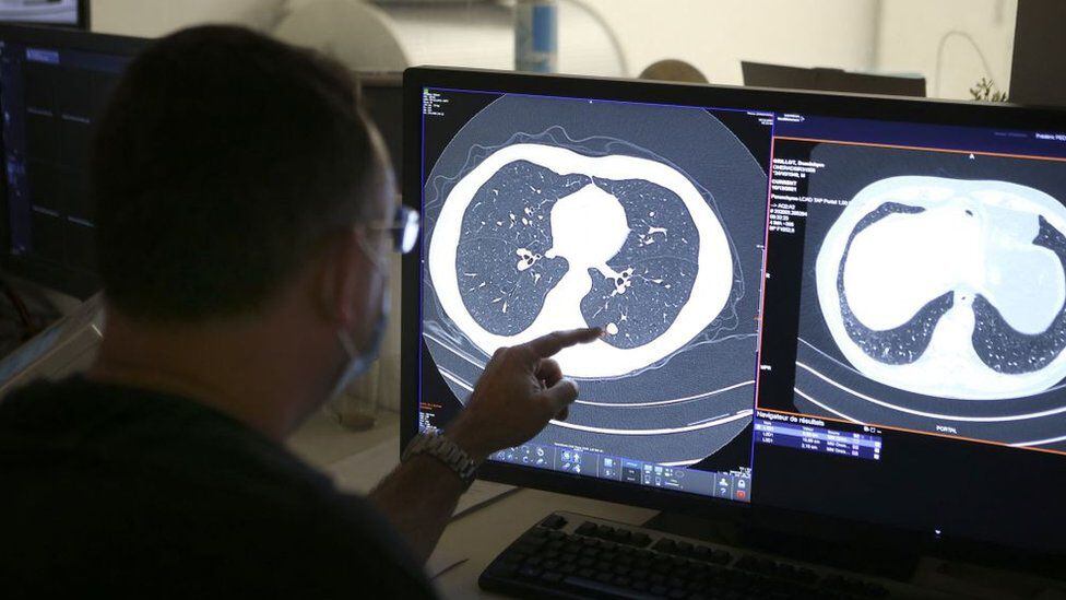 Traditional surgery to remove a lung tumor (like the one pictured in this file photo) is invasive and leaves scars.  (GETTY IMAGES).